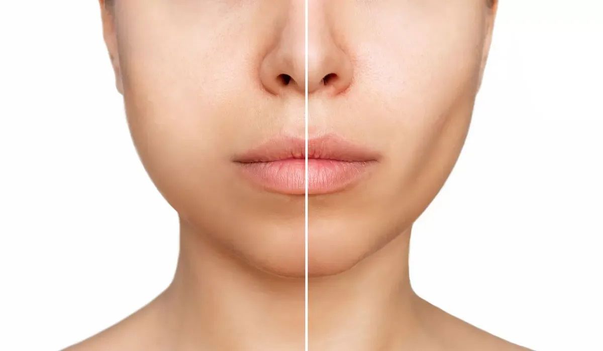 جراحی بوکال فت 