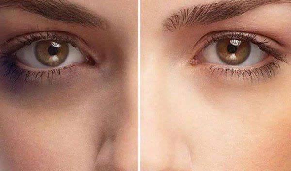 رفع تیرگی زیرچشم