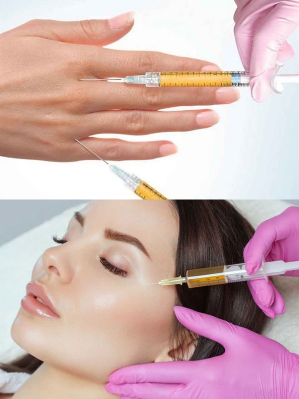 PRP دست و صورت 