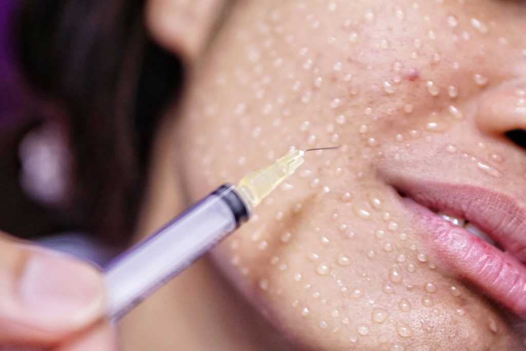 مزوتراپی صورت 